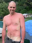 new_zealand__2007____0501___sunburn
